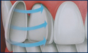 La facette dentaire se pose directement sur la dent